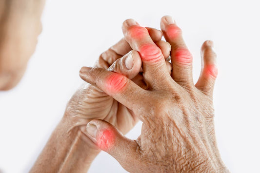 elderly man with arthritic hand, with red swollen nodules and joints in fingers and thumbs